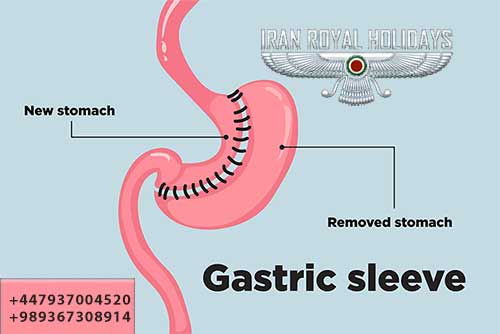 gastric sleeve in iran